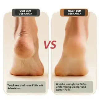 SmoothSole - pain-free feet in just a few minutes