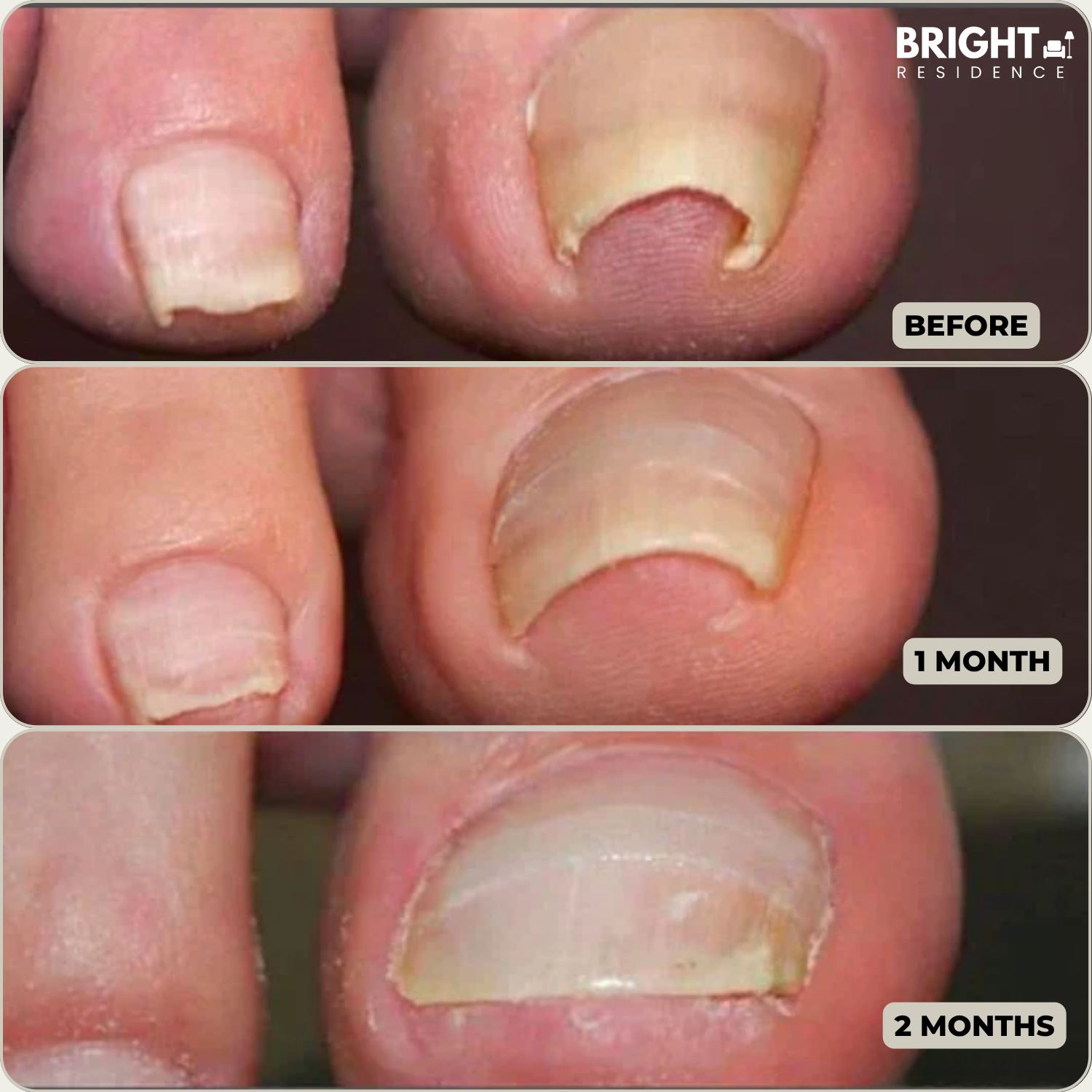 FixaNail™ - Correction Patches for Beautiful and Healthy Nails